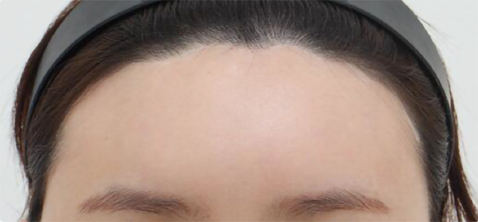 脂肪過剰注入、異物除去