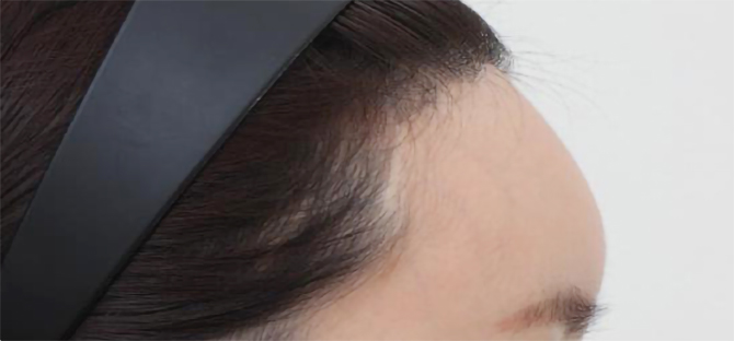 脂肪過剰注入、異物除去