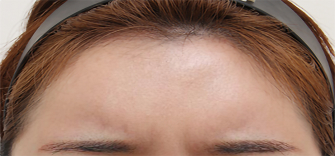 脂肪過剰注入、異物除去