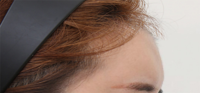 脂肪過剰注入、異物除去