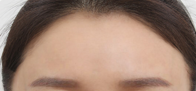 脂肪過剰注入、異物除去