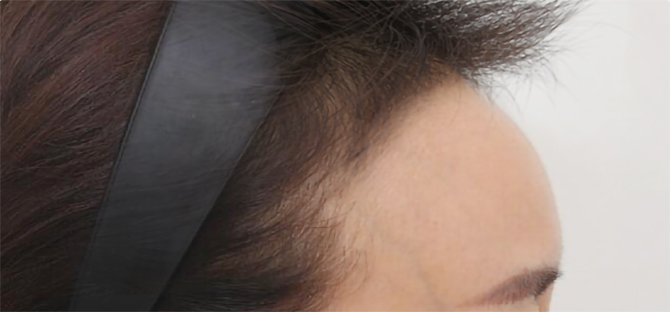 脂肪過剰注入、異物除去