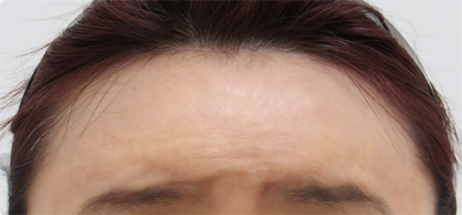 脂肪過剰注入、異物除去