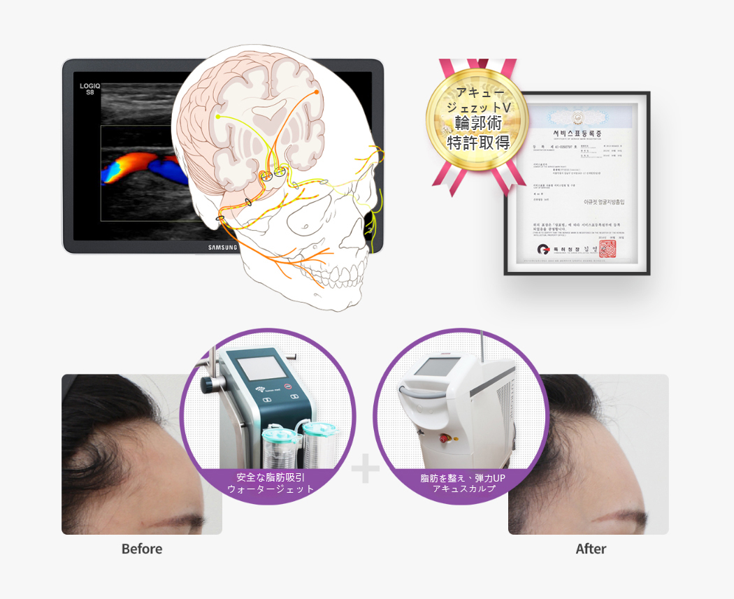 脂肪過剰注入、異物除去