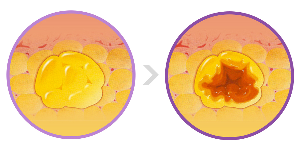 脂肪過剰注入、異物除去