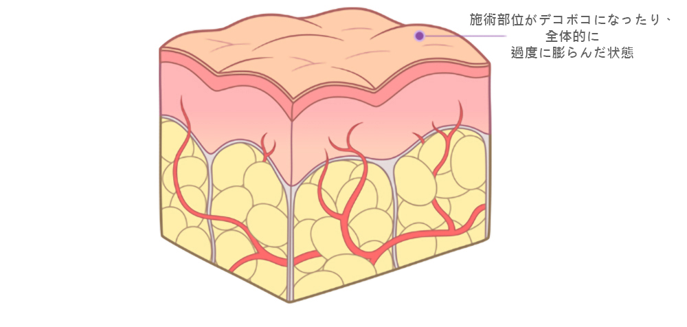 脂肪過剰注入、異物除去