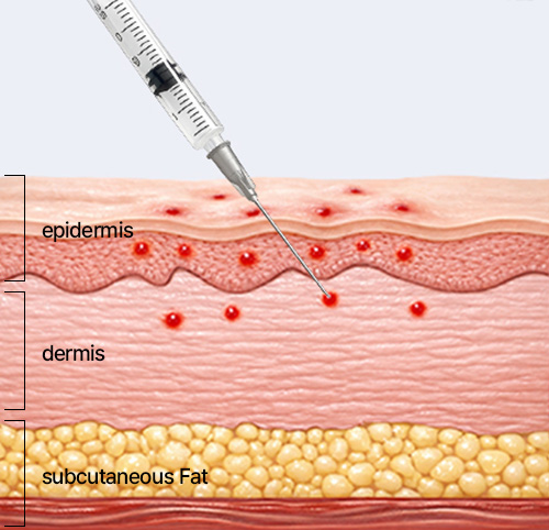 손주사 시술 이미지