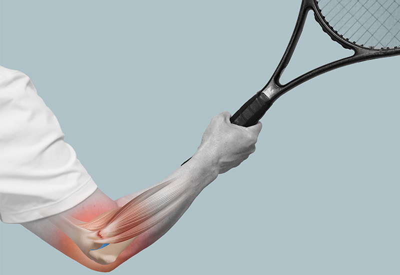 골프·테니스엘보