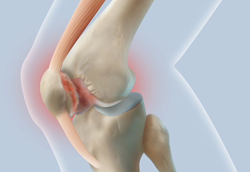 인대·연골 손상